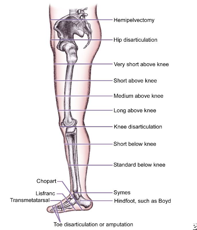 Lower Extremity Amputations